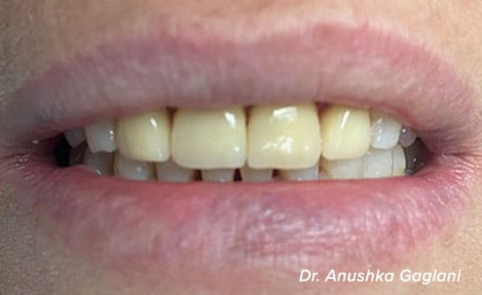 Dental Implants Dentist in Steger IL