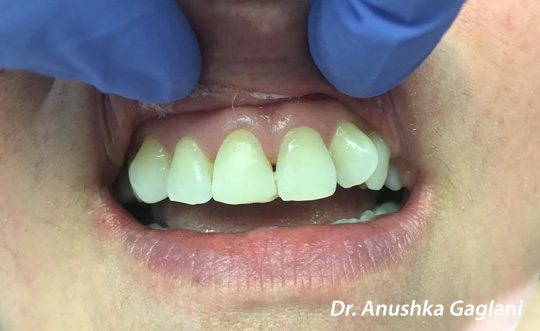 Steger Smiles Family Dentistry | E4D, Dentures and Invisalign reg 