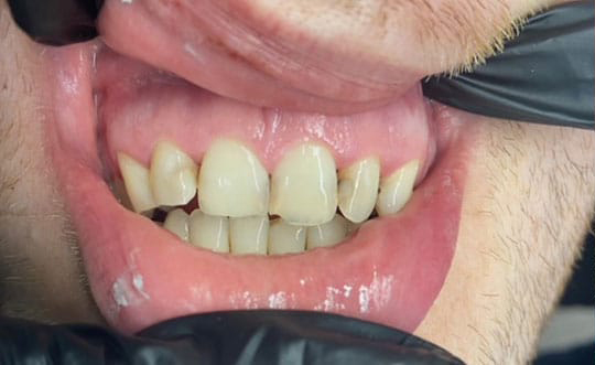 Dental Implants Dentist in Steger IL