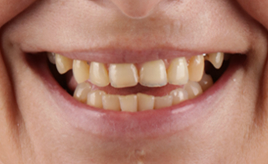 Steger Smiles Family Dentistry | Dentures, Extractions and Root Canals