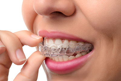 Invisalign in Steger IL