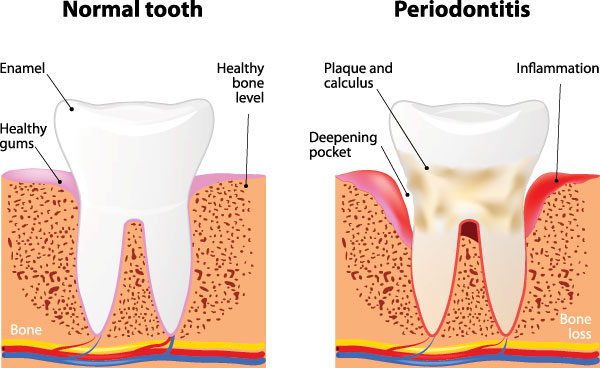 Steger Smiles Family Dentistry | Night Guards, Ceramic Crowns and E4D