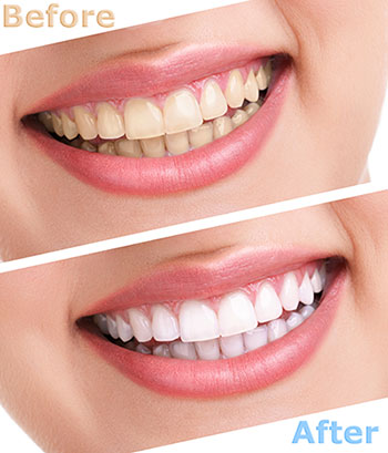 Steger Smiles Family Dentistry | Ceramic Crowns, Veneers and Implant Dentistry